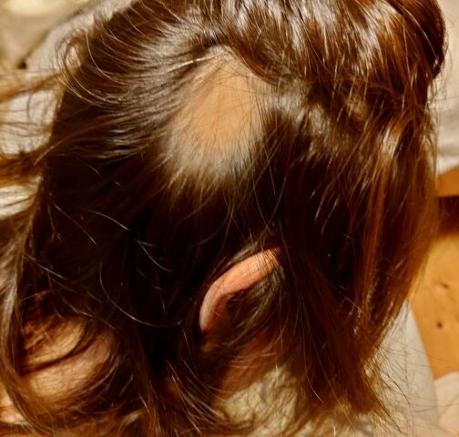 産後脱毛症とは？原因と正しい対策を解説｜堺市 美原区 かりの鍼灸整骨院